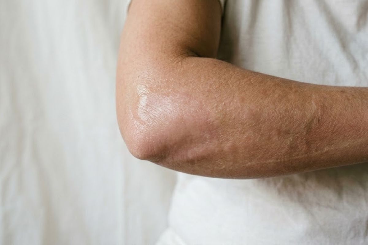 After treatment